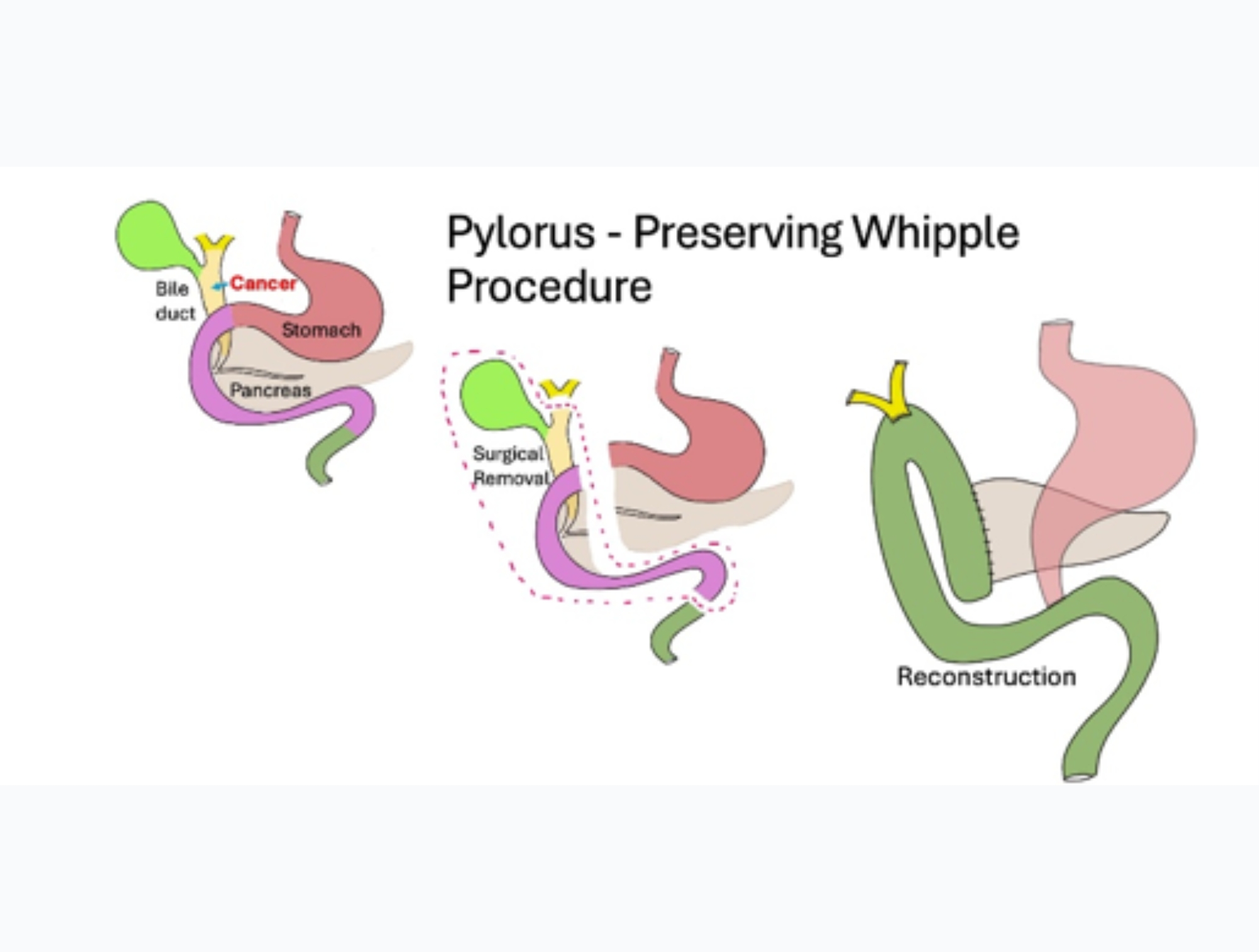 Robotic Pylorus – Preserving Whipple Procedure